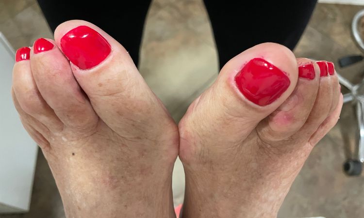 rekonstrukcija uništenog nokta