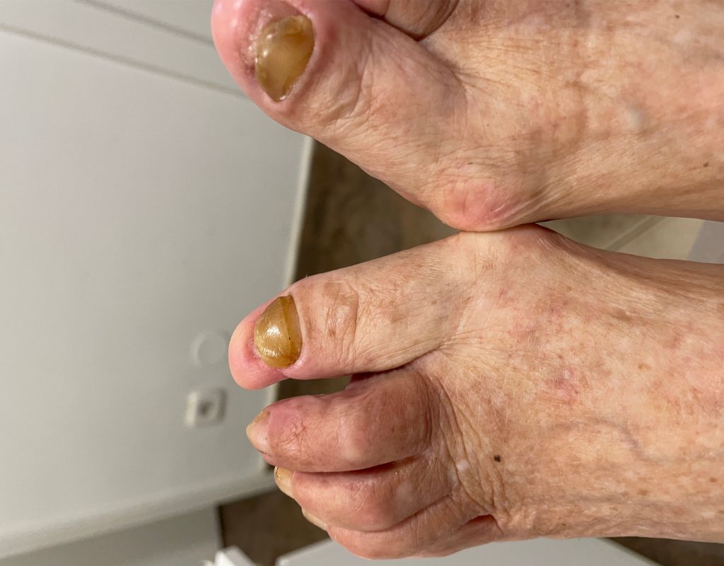 rekonstrukcija-unistenog-nokta